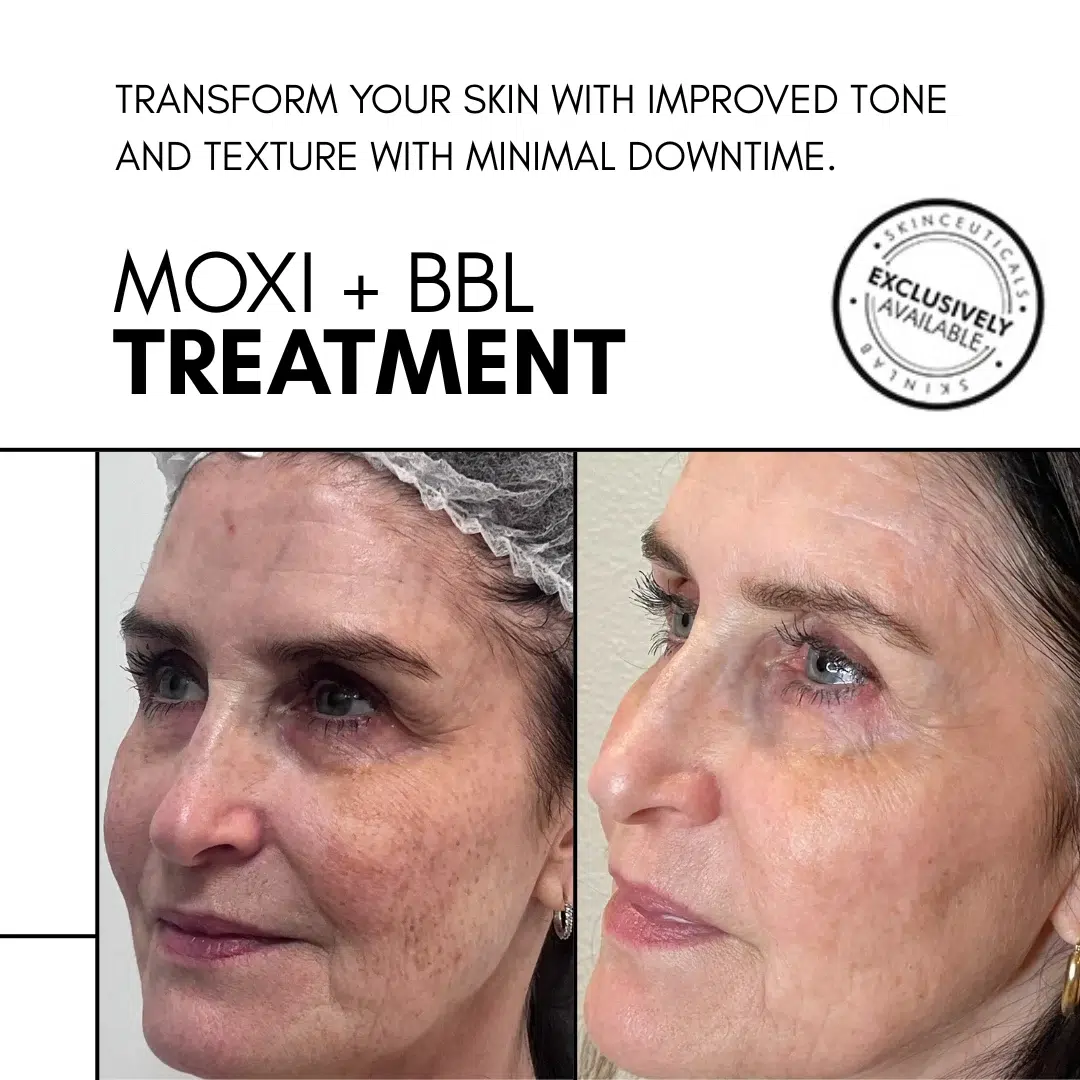 Moxi and BBL Before After SkinLab NYC Moxi and BBL Before After SkinLab NYC