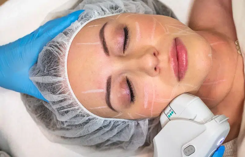 Ultherapy woman
